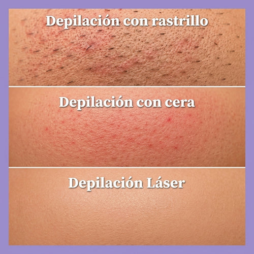 Depiladora Láser IPL para Uso en Casa