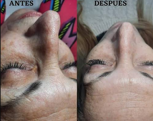 Espátula Ultrasónica Facial - Limpieza y Lifting